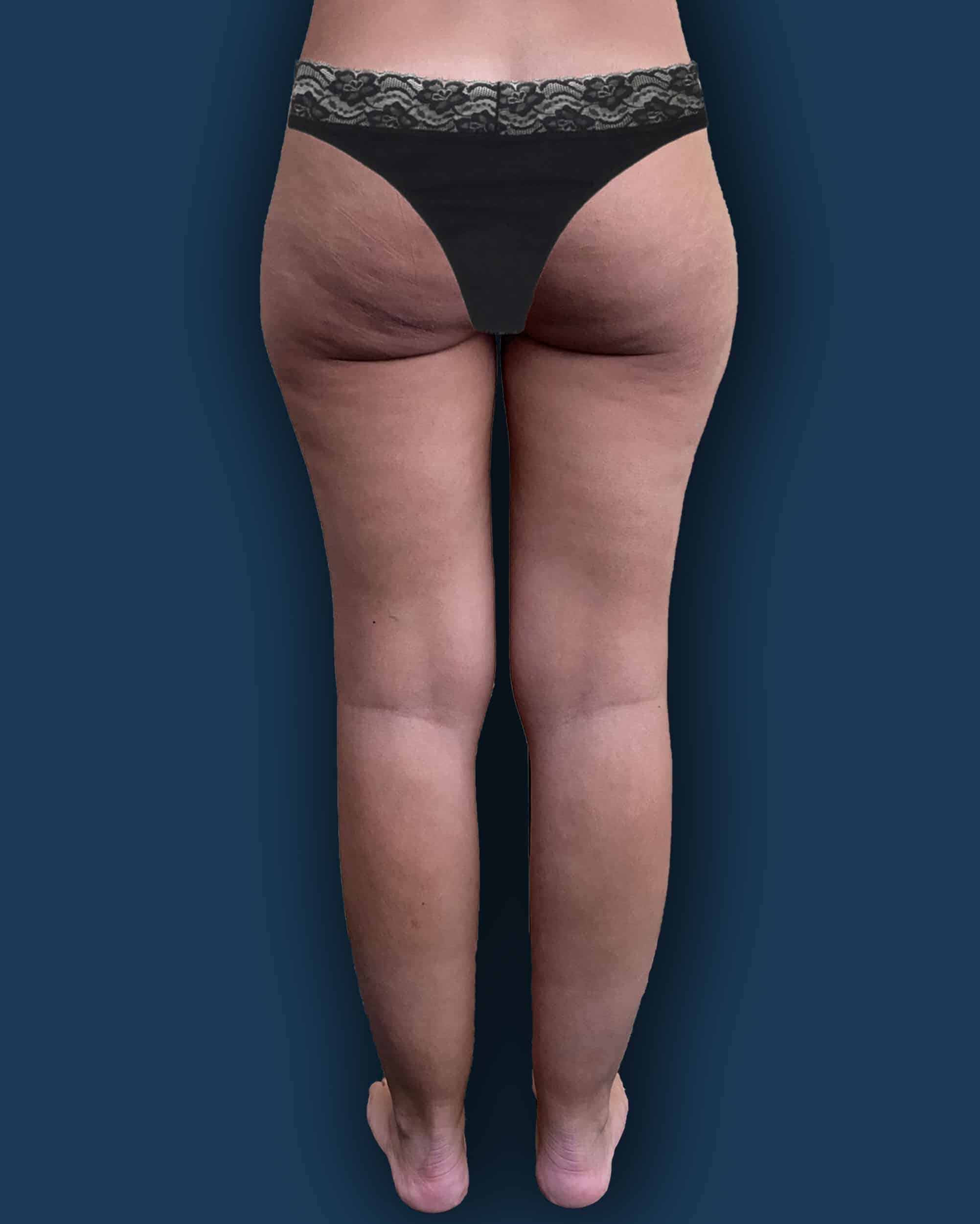 Antes de la cirugía en Instituto Rubí — Cirugía de lipedema en piernas · reducción de volumen
