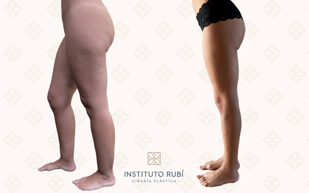 Antes y después en Instituto Rubí — Cirugía de lipedema · piernas, rodillas y tobillos · Vista lateral