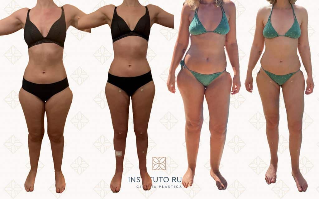 Antes y después en Instituto Rubí — Remodelación corporal en paciente con lipedema · Vista frontal