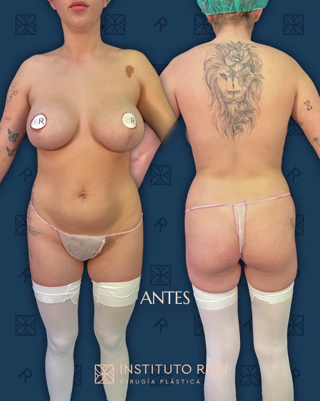 Resultado de la remodelación corporal de Judith Arias