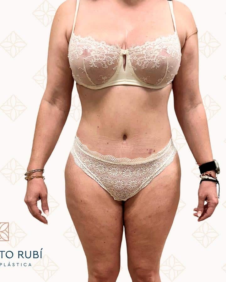 Después de la cirugía en Instituto Rubí — Recuperación de la proporción cuerpo-piernas