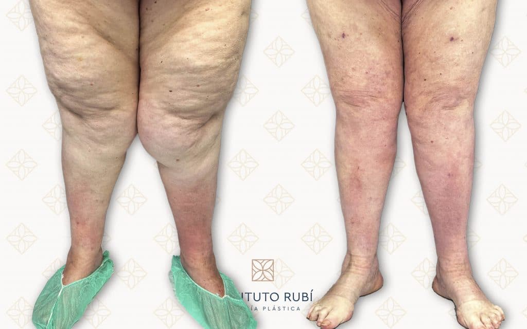 Antes y después en Instituto Rubí — Cirugía de lipedema · piernas, rodillas y tobillos · Vista frontal
