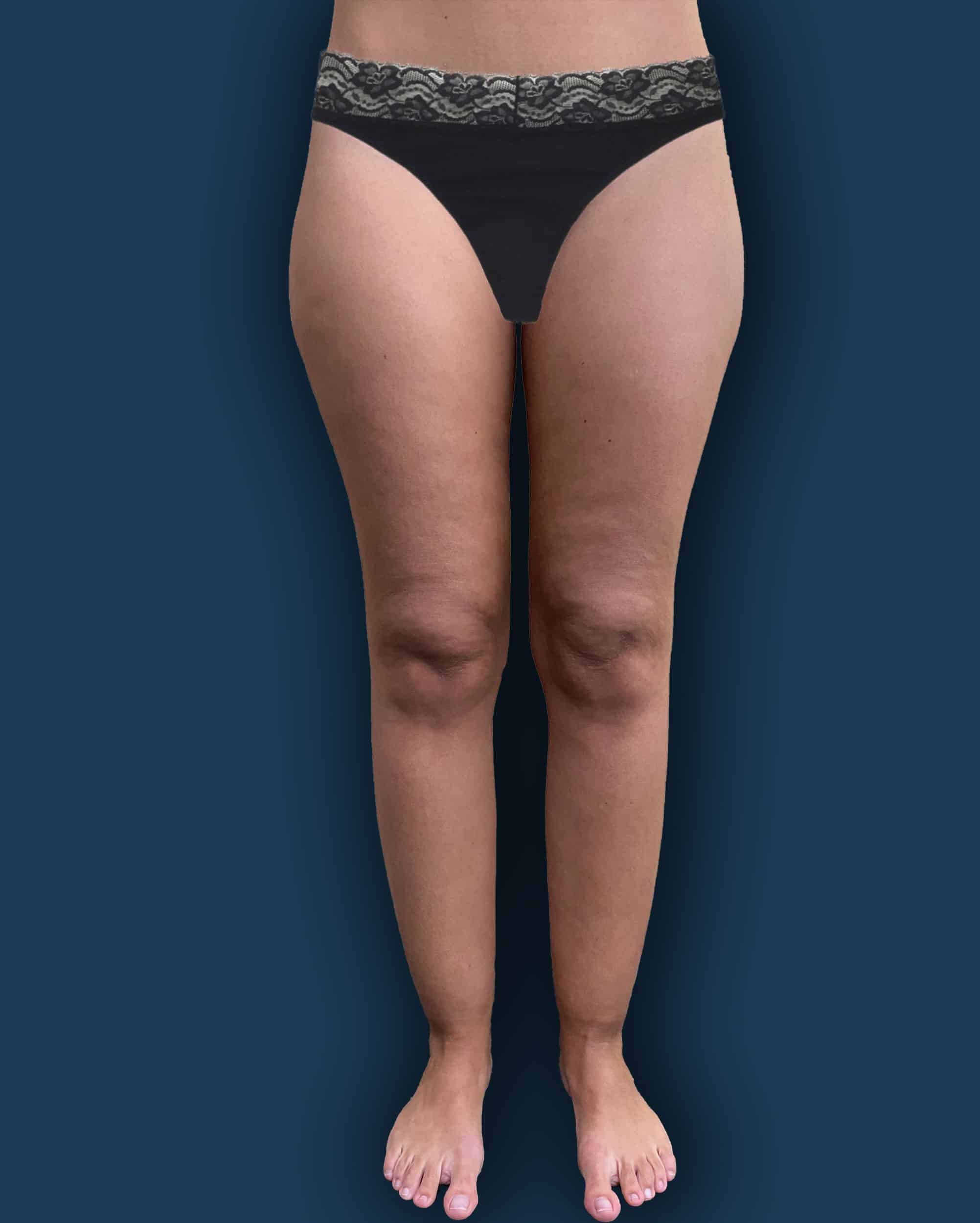 Antes de la cirugía en Instituto Rubí — Cirugía de lipedema · contorno de muslos y rodillas