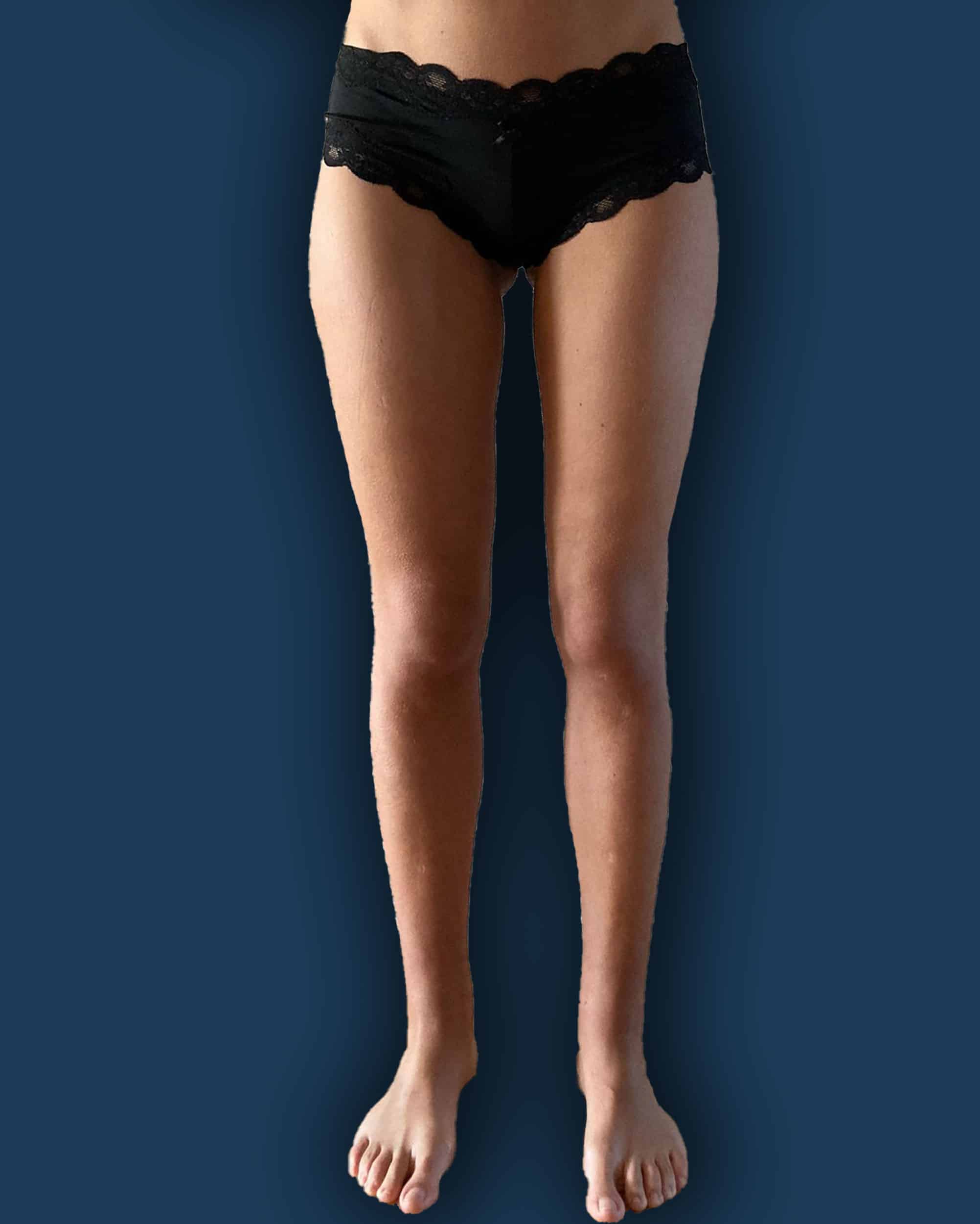 Después de la cirugía en Instituto Rubí — Cirugía de lipedema · contorno de muslos y rodillas