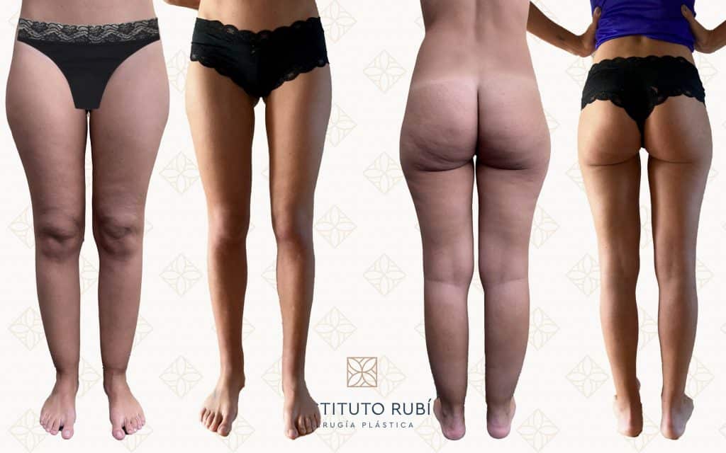 Antes y después en Instituto Rubí — Remodelación corporal en paciente con lipedema · Vista frontal y posterior